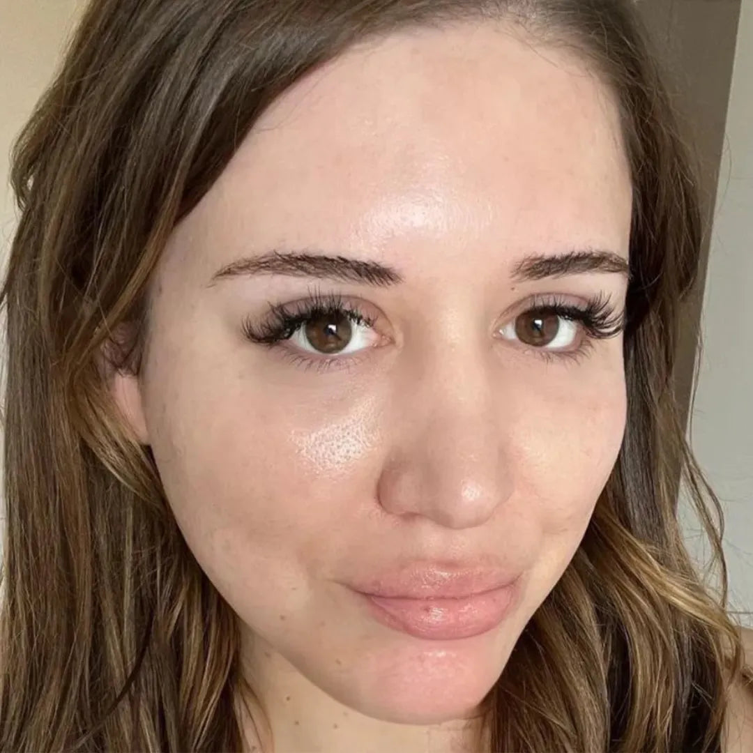 Pele com acne: depois